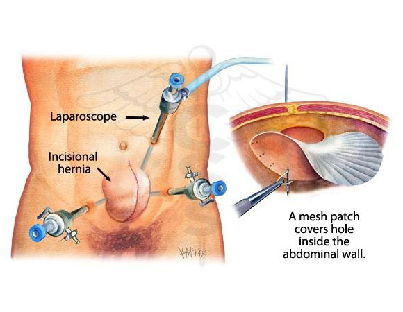 hernia surgery in delhi 