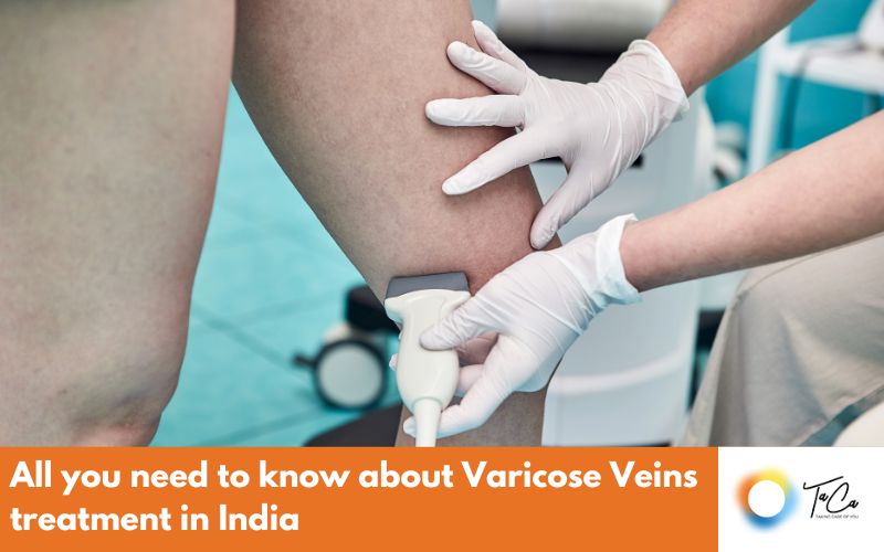 All you need to know about Varicose Veins treatment in India